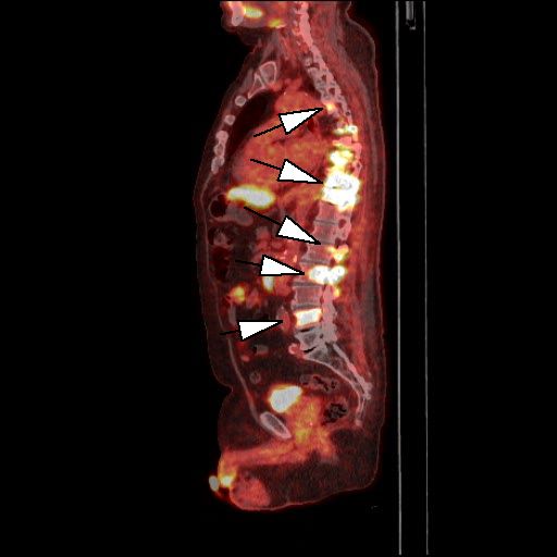 Obr. 2: PET/CT f�ze, sagit�ln� �ez. Lo�iska patologicky zv��en�ho z�chytu 18F-piflufolastatu v metast�z�ch v p�te�i (hroty �ipek).