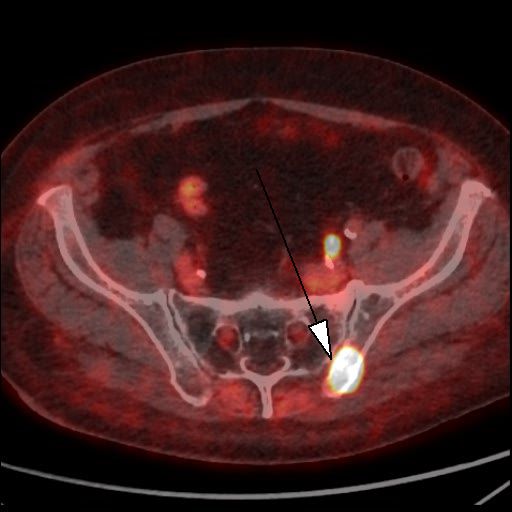 Obr. 3: PET/CT f�ze, transverz�ln� �ez. Lo�isko patologicky zv��en�ho z�chytu 18F-piflufolastatu v kosti ky�eln� vlevo (hrot �ipky).