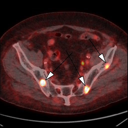 Obr. 4: PET/CT f�ze, transverz�ln� �ez. Lo�iska patologicky zv��en� akumulace 18F-piflufolastatu v kosti ky�eln� vlevo a vpravo (hroty �ipek).