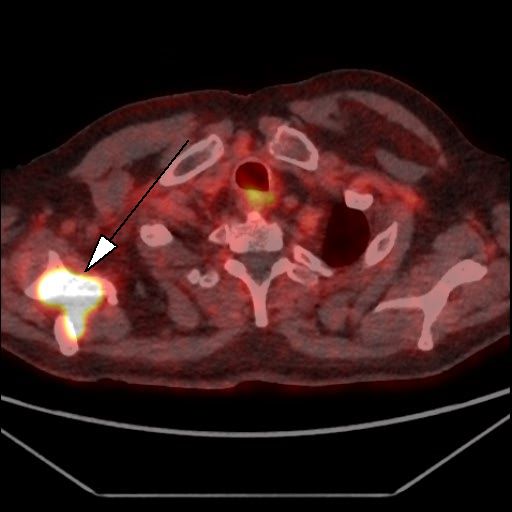 Obr. 5:PET/CT f�ze, transverz�ln� �ez. Lo�iska patologicky zv��en� akumulace 18F-piflufolastatu v prav� lopatce (hrot �ipky).