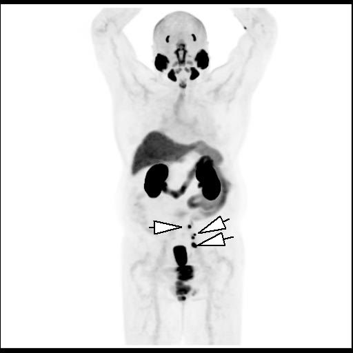 Obr. 1: 3D PET MIP rekonstrukce. Lo�iska patologicky zv��en� akumulace 18F-piflufolastatu v lymfatick�ch uzlin�ch parailicky vlevo (hroty �ipek).