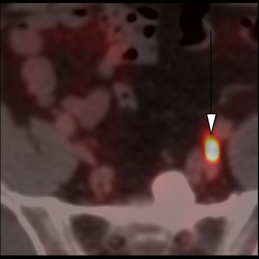 Obr. 2: PET/CT f�ze, transverz�ln� �ez. Lo�isko patologicky zv��en�ho z�chytu 18F-piflufolastatu v lymfatick� uzlin� parailicky vlevo (hrot �ipky).