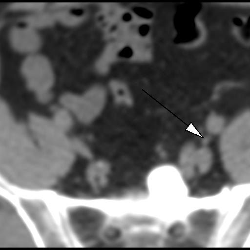 Obr. 3: CT, transverz�ln� �ez. Lymfatick� uzlina parailicky vlevo (hrot �ipky).