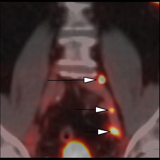 Obr. 4: PET/CT f�ze, koron�rn� �ez. Lo�iska patologicky zv��en� akumulace 18F-piflufolastatu v lymfatick�ch uzlin�ch parailicky vlevo (hroty �ipek).