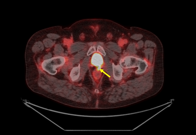 Obr. 1: F�zovan� PET/CT obraz mal� p�nve � transaxi�ln� �ez. Fok�ln� lo�isko zv��en� akumulace 1 F-DCFPyL dorz�ln� p�i mo�ov�m m�ch��i vlevo v oblasti l��ka po radik�ln� prostatektomii, velikosti 8 � 8 mm, SUVmax 13,77. N�lez odpov�d� izolovan� lok�ln� recidiv� karcinomu prostaty.