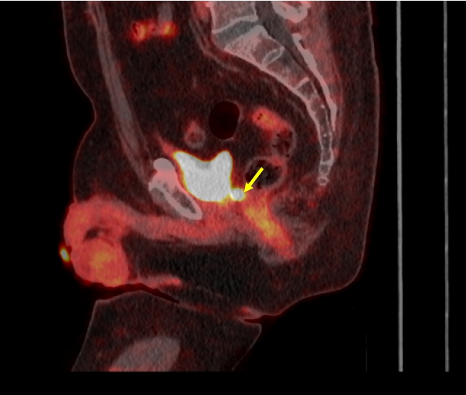 Obr. 2: F�zovan� PET/CT obraz (sag.). F�zovan� zobrazen� PET a CT potvrzuje p�esnou anatomickou lokalizaci patologick� akumulace v oblasti l��ka po prostatektomii dorz�ln� p�i mo�ov�m m�ch��i.