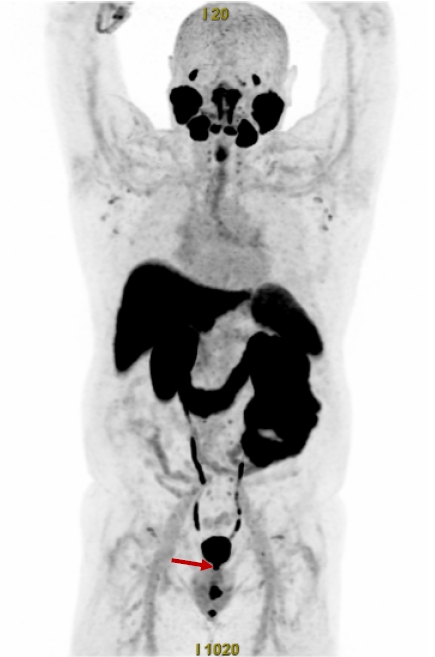 Obr. 3: MIP projekce 18F-PSMA PET s fyziologickou biodistribuc� a fok�ln� patologickou akumulac� v l��ku po prostatektomii.