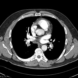 Obr. č. 5: CT plicní angiografie