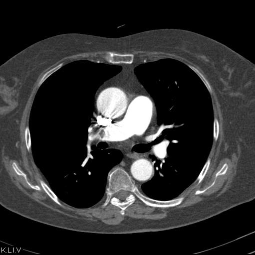 Obr. č. 2: CT plicní angiografie