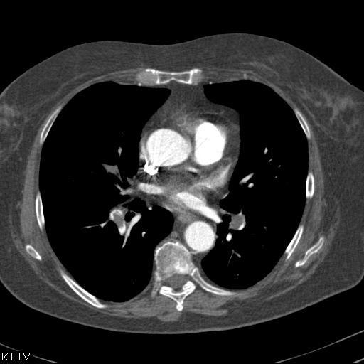 Obr. č. 4: CT plicní angiografie