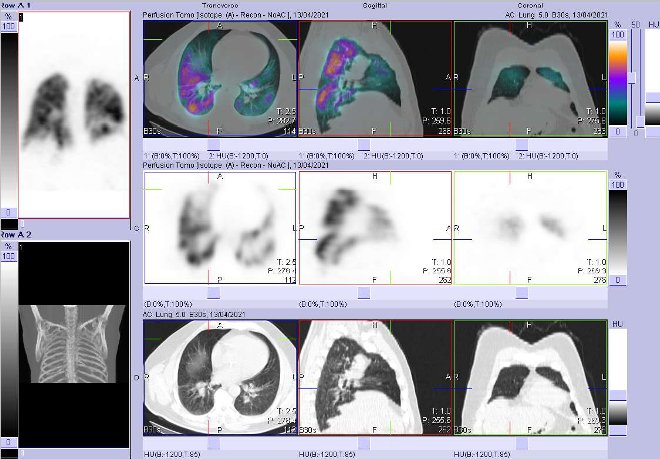 Obr. č. 3 - 7: SPECT/CT plic se zaměřením na vícečetné perfuzní defekty v obou plicních křídlech.