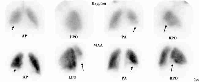 TechneScan LyoMAA / Krypton generator