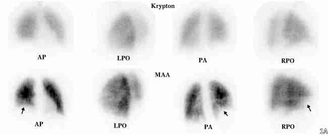 TechneScan LyoMAA / Krypton generator