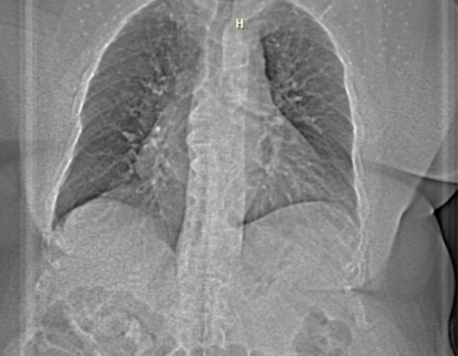 Obr. . 1: CT angiografie plcnice.