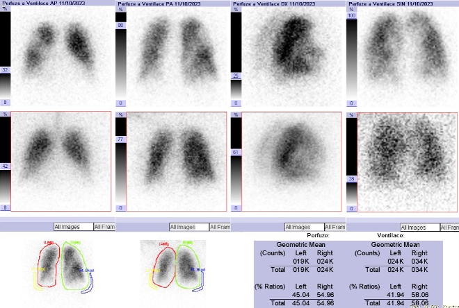 Obr. . 2: Kombinovan perfuzn a ventilan scintigrafie plic. Horn ada scintigram  perfuze, doln ada scintigram - ventilace.