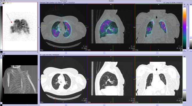 Obr. . 3 - 10: SPECT/CT plic.