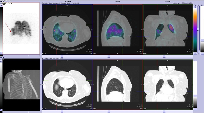 Obr. . 3 - 10: SPECT/CT plic.