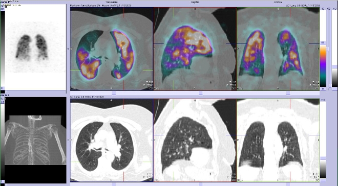Obr. . 3 - 10: SPECT/CT plic.