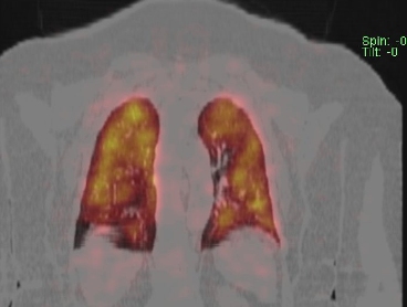 Obr. . 3 - 10: SPECT/CT plic.