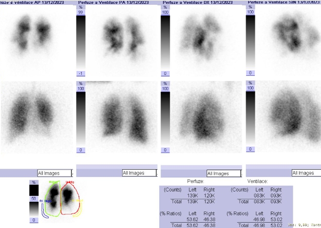 Obr. . 2: Kombinovan perfuzn a ventilan scintigrafie plic. Horn ada scintigram  perfuze, doln ada scintigram  ventilace.