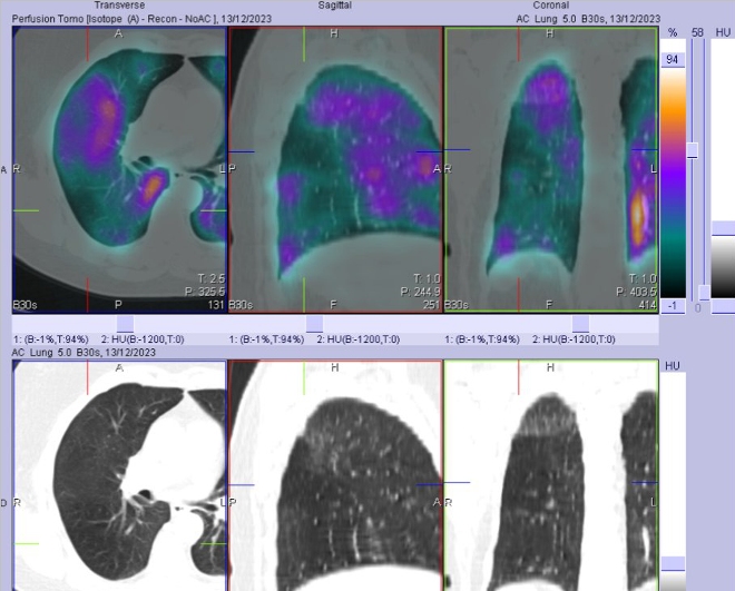 Obr. č. 2-5: SPECT/CT plic - perfuze.