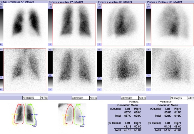 Obr.1: Kombinovaná perfuzní a ventilační scintigrafie plic. Horní řada scintigramů – perfuze, dolní řada scintigramů – ventilace.