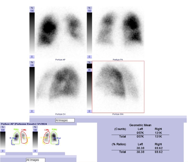 Obr. �. 1: Perfuzni scintigrafie plic.