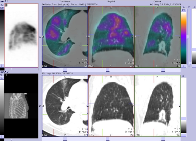 Obr. �. 2-4: Perfuzn� SPECT/CT plic.