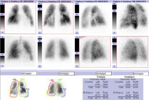 Obr. �. 1: Kombinovan� perfuzn� a ventila�n� scintigrafie plic. Horn� �ada scintigram� � perfuze, doln� �ada scintigram� � ventilace.