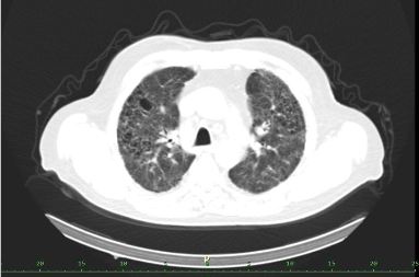 Obr. �. 8-10: ldCT plic v r�mci vy�et�en� SPECT/CT.
