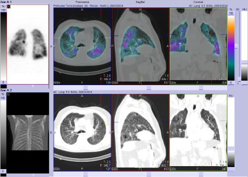 Obr. �. 2-7: SPECT/CT plic se zam��en�m na v�ce�etn� perfuzn� defekty v obou plicn�ch k��dlech.