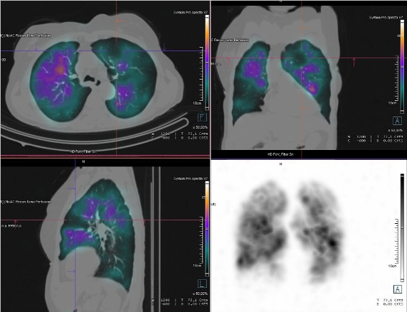Obr. �. 2-3: SPECT/CT plic se zam��en�m na v�ce�etn� perfuzn� defekty v obou plicn�ch k��dlech.