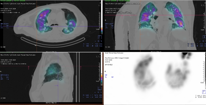 Obr. č. 2-5: SPECT/CT plic se zaměřením na vícečetné perfuzní defekty v obou plicních křídlech.