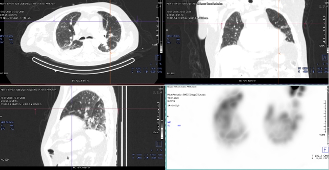 Obr. č. 6-7: ldCT plic v rámci vyšetření SPECT/CT.
