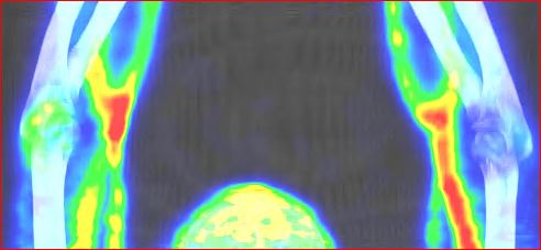 Obr.1.: SPECT/CT v MIP projekci - zv��en� krevn� pool v oblasti synovi�ln� membr�ny prav�ho loketn�ho kloubu.