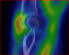 Obr.2.: SPECT/CT v koron�rn�m �ezu - zv��en� krevn� pool v oblasti synovi�ln� membr�ny prav�ho loketn�ho kloubu.