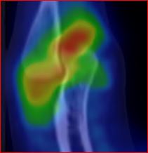 Obr.3.: SPECT/CT v sagit�ln�m �ezu - zv��en� krevn� pool v oblasti synovi�ln� membr�ny prav�ho loketn�ho kloubu.