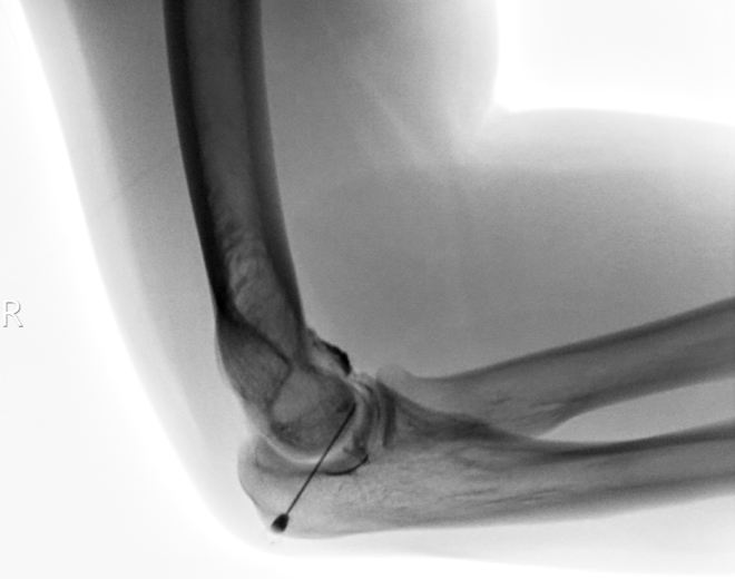 Obr.4.: RTG sn�mek prav�ho lokte � punkce kloubu pod RTG kontrolou s pod�n�m KL.