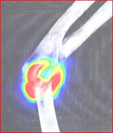 Obr.5.: SPECT/CT distribu�n� scintigrafie v MIP projekci � RF v prav�m loketn�m kloubu.