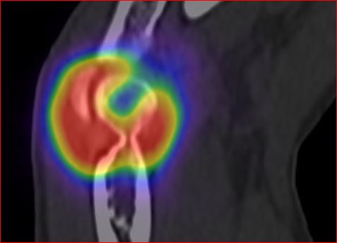 Obr.6.: SPECT/CT distribu�n� scintigrafie v koron�rn�m �ezu � RF v prav�m loketn�m kloubu.