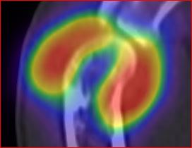 Obr.7.: SPECT/CT distribu�n� scintigrafie v sagit�ln�m �ezu � RF v prav�m loketn�m kloubu.