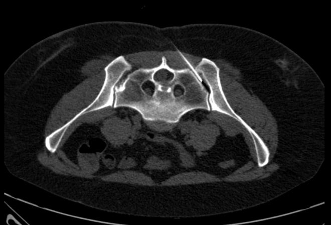 Obr.1.: Aplikace RF pod CT kontrolou � lev� SI sklouben�.