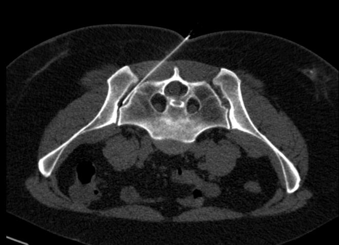 Obr.2.: Aplikace RF pod CT kontrolou - prav� SI sklouben�.