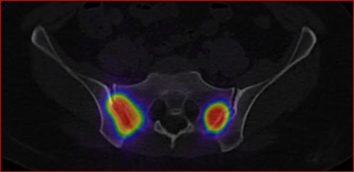Obr.3.: SPECT/CT Distribu�n� scintigrafie � distribuce RF v obou SI sklouben�ch.