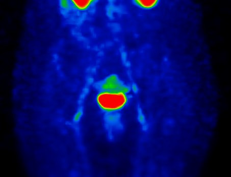 Obr.4.: SPECT krevn�ho poolu v MIP projekci p�i kontroln� scintigrafii � norm�ln� n�lez.