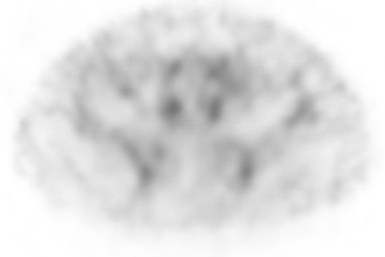 Obr.5.: SPECT krevn�ho poolu v axi�ln�m �ezu p�i kontroln� scintigrafii - norm�ln�  n�lez.