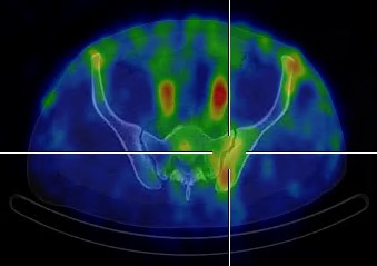 Obr.1.: SPECT/CT v axi�ln�m �ezu - zv��en� krevn� pool v oblasti lev�ho SI sklouben�.