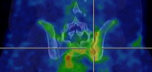 Obr.2.: SPECT/CT v koron�rn�m �ezu - zv��en� krevn� pool v oblasti lev�ho SI sklouben�.