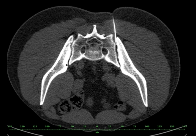 Obr.3.: Aplikace RF pod CT kontrolou - zaveden� jehly do lev�ho SI sklouben�.