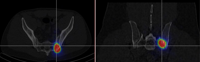 Obr.4.: SPECT/CT distribu�n� scintigrafie v axi�ln�m a koron�rn�m �ezu  - RF v lev�m SI sklouben�.